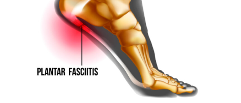 Effective Strategies For Plantar Fasciitis w/ Kay Warren