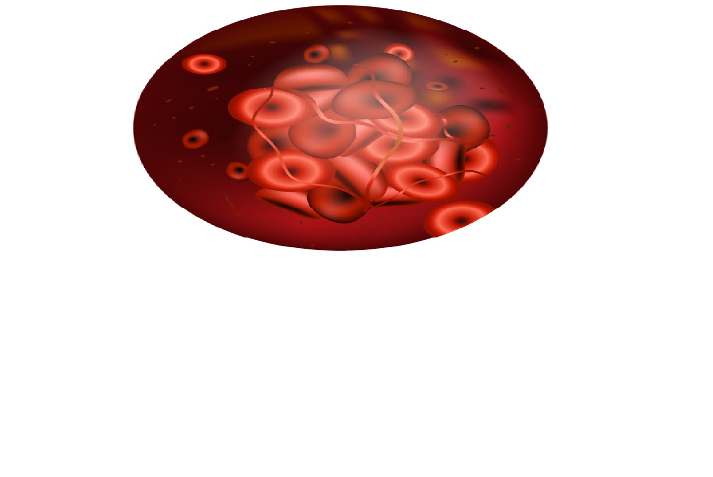 Anticoagulation Options in Continuous Kidney Replacement Therapy (CKRT)