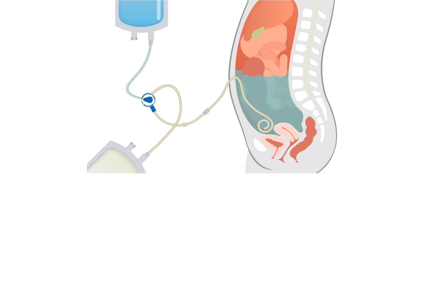 Prevention and Management of Infectious Peritoneal Dialysis Complications