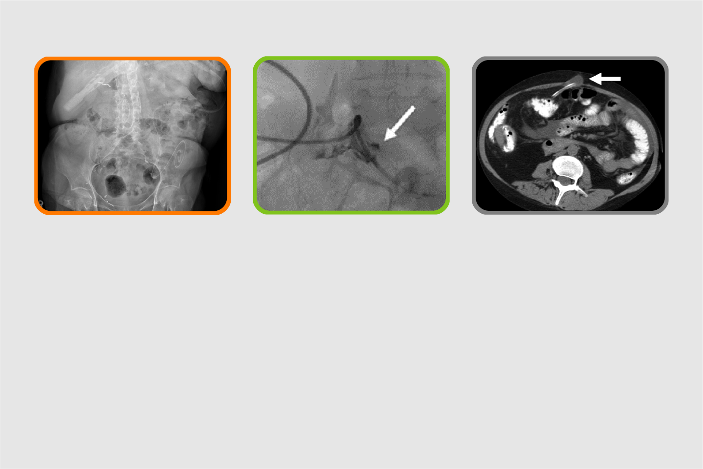 Clinical and Surgical Management of Non-Infectious Complications in PD 