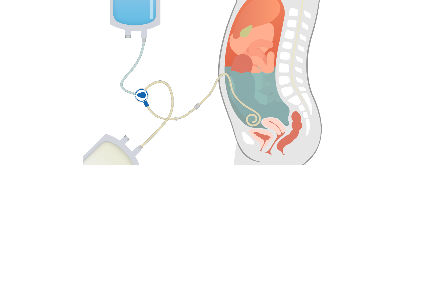 Peritoneal Dialysis: Is it Time to Reconsider the Role of CAPD?